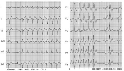 Substrate Asymptomatic Coronary Artery Disease Dilated (non-ischemic) Cardiomyopathy Hypertrophic