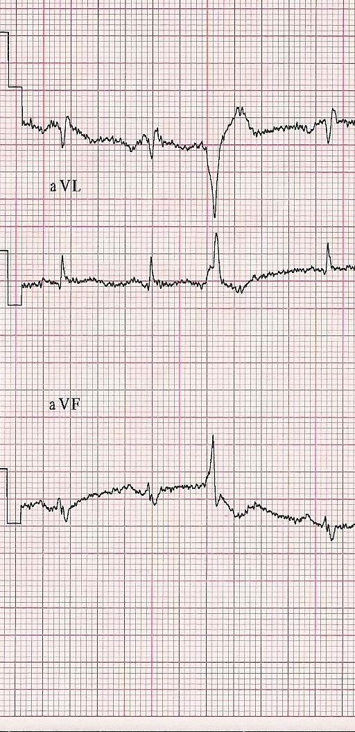 disease Coro: (-) I II avr avl V1 V2