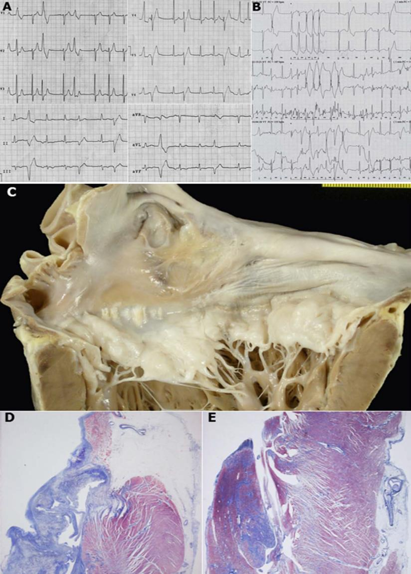 650 young adults ( 40 y) with SCD - Cardiac pathology registry 43