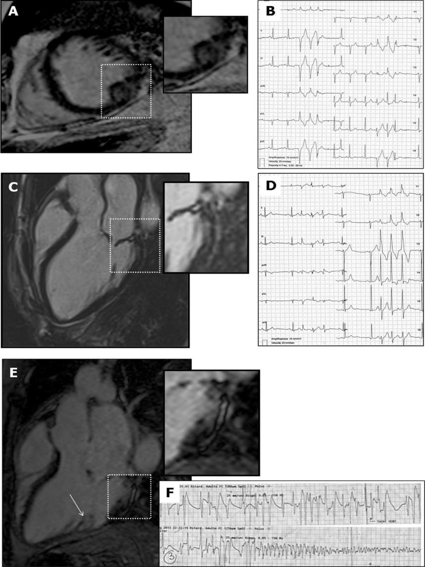 the only cause of SCD were identified (7% of all SCD, 13% of women).