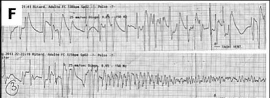 Left ventricular fibrosis was detected at histology at the level of