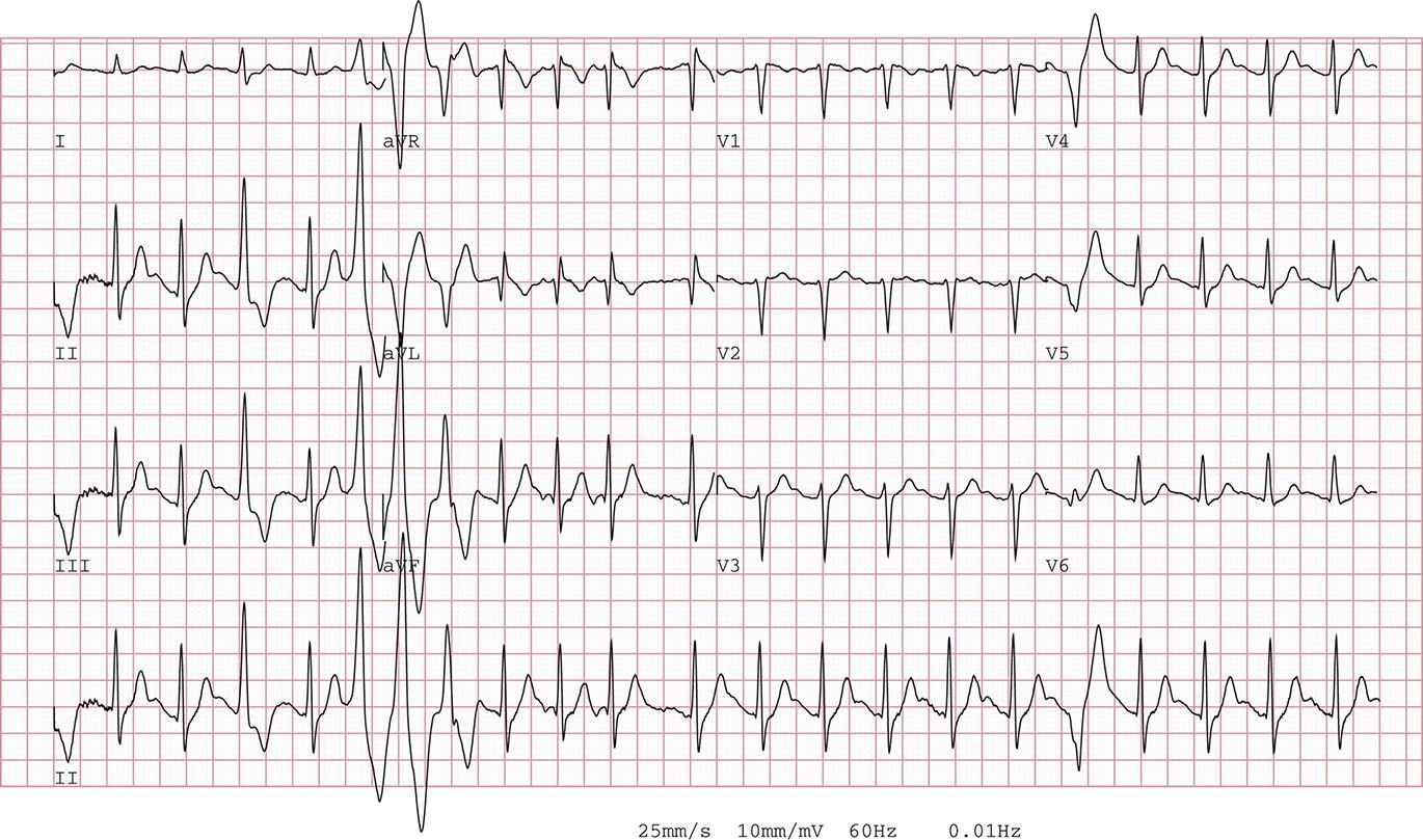 Ventricular Arrhythmias