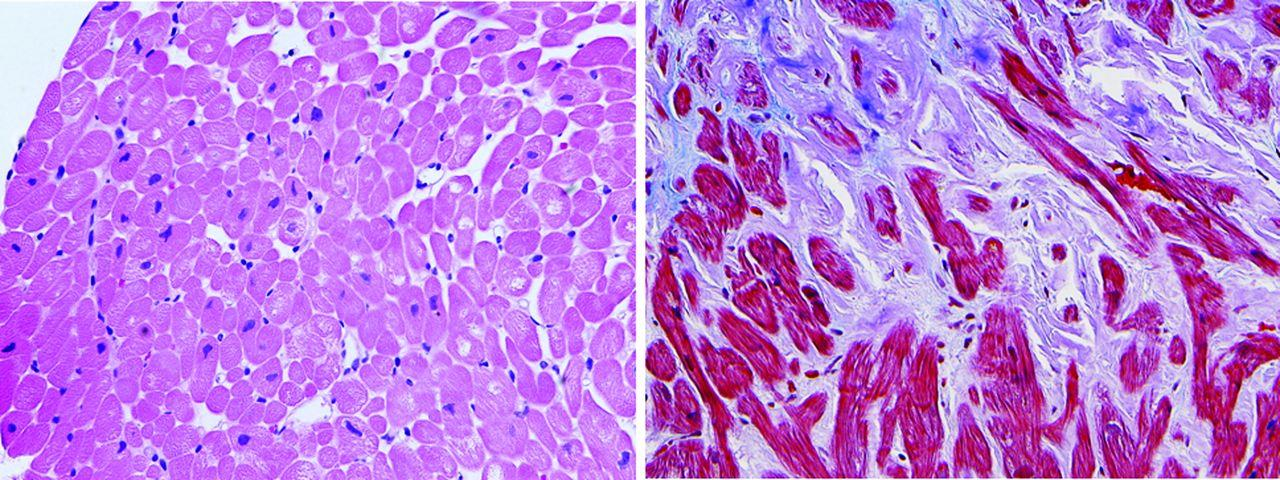 Cardiac biopsies (original magnification 400) showing normal findings (left) and extensive amyloid infiltration (right).