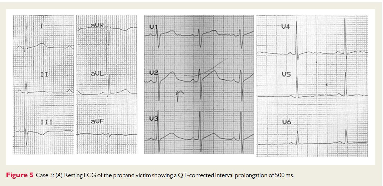 QTc : 500 msec LQTS missense