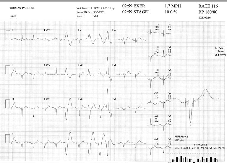 HOLTER ΡΥΘΜΟΥ ΔΟΚΙΜΑΣΊΑ ΚΟΠΩΣΗΣ