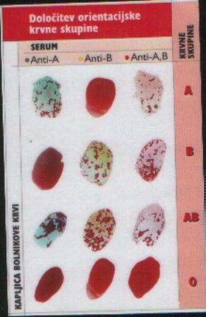 Slika 32: Določanje ABO na ploščici. Za določanje krvne skupine uporabljamo serume, v katerih je večja količina antigenov - aglutininov.