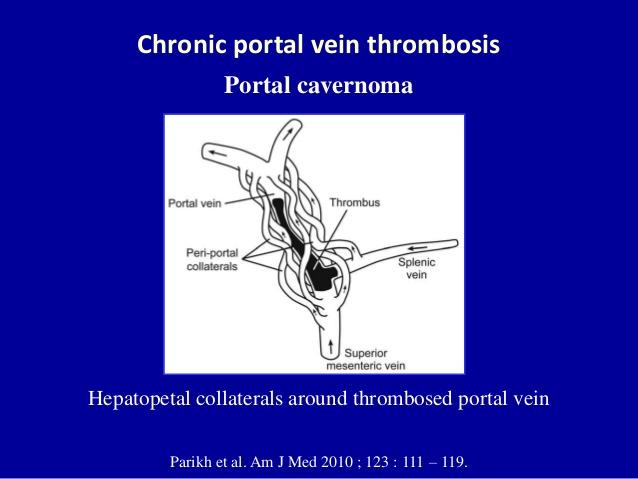 Εξωηπατική PVT στην κίρρωση Μερική (~10%) Αποφρακτική (~3%) Αυτόματη ύφεση (~40%) Τόσο τα αιμορραγικά όσο και τα θρομβωτικά επεισόδια είναι αυξημένα σε κιρρωτική PVT