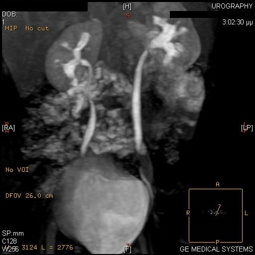 νεφρική ουλή ή κύστη στον κάτω πόλο του ΑΡ νεφρού, β) Στεφανιαία λήψη MRU: Τριγωνική εντομή στον κάτω πόλο του ΑΡ νεφρού, διευκρινίζοντας ότι πρόκειται για νεφρική ουλή.