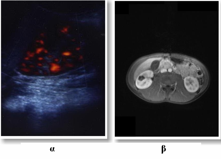 Εικόνα 49. α) ECHO Doppler: μόρφωμα με σαφή όρια χωρίς αγγείωση στη μεσότητα του ΔΕ νεφρού, β) MRU: κυστικό μόρφωμα, με εσωτερικά διαφράγματα και περιεχόμενο με ένταση σήματος ανάλογη του ύδατος.