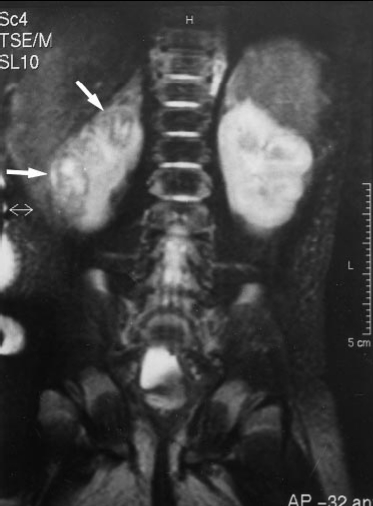 Εικόνα 10. Κορίτσι (νεογνό) 10 ημερών, με νεφρογενή υπέρταση και θρομβωτικές περιοχές στο ΔΕ νεφρό (βέλη) 59.