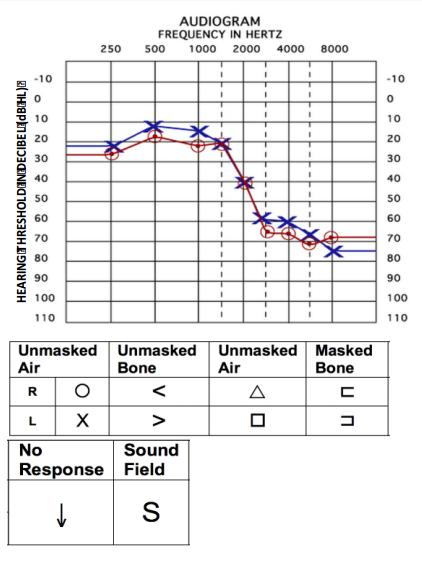 Φυσιολογική ακοή (0-25dB): Σε αυτό το επίπεδο, η ακοή είναι μέσα στα φυσιολογικά όρια.