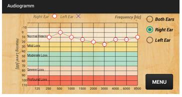 Το ακοόγραμμα έχει χρωματισθεί ώστε να γίνει ευδιάκριτος ο διαχωρισμός του βαθμού απώλειας ακοής ως εξής: Φυσιολογική ακοή (-10-20dB), Ήπια απώλεια ακοής (21-40dB), Μέτρια απώλεια ακοής (41-70dB),