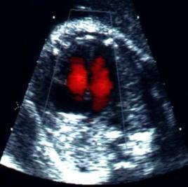 διαγνωστική και μοριακή απεικόνιση με υπέρηχους υπερηχοτομογραφία καρδιά εμβρύου (27 βδομάδα κύησης) www.med.upenn.