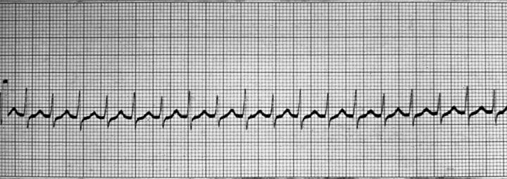 Supraventrikulárne tachykardie 3 a viacej QRS (norma) s fr.