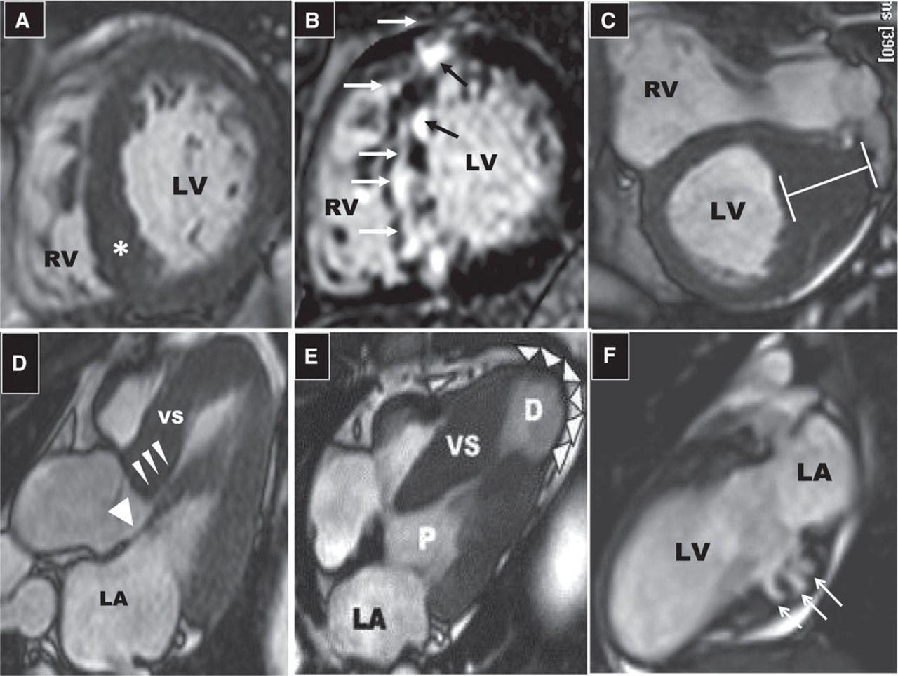 CMR for HCM diagnosis and phenotypic characterization with