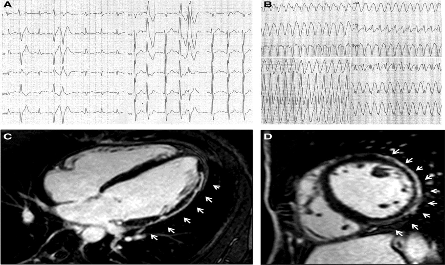42-y-old martial art player presenting with frequent and coupled premature ventricular beats with right bundle branch
