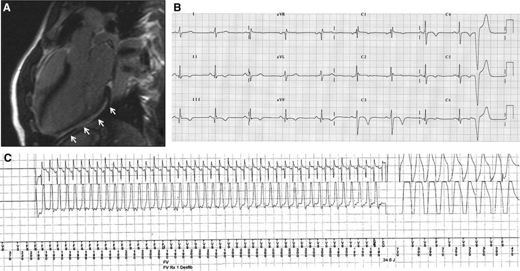A 23-y-old soccer player who suffered syncope during a