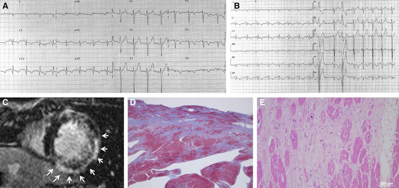 A 18-y-old tennis player who underwent contrast-enhancement cardiac magnetic resonance for inferolateral T-wave inversion at baseline 12-lead ECG (A) and