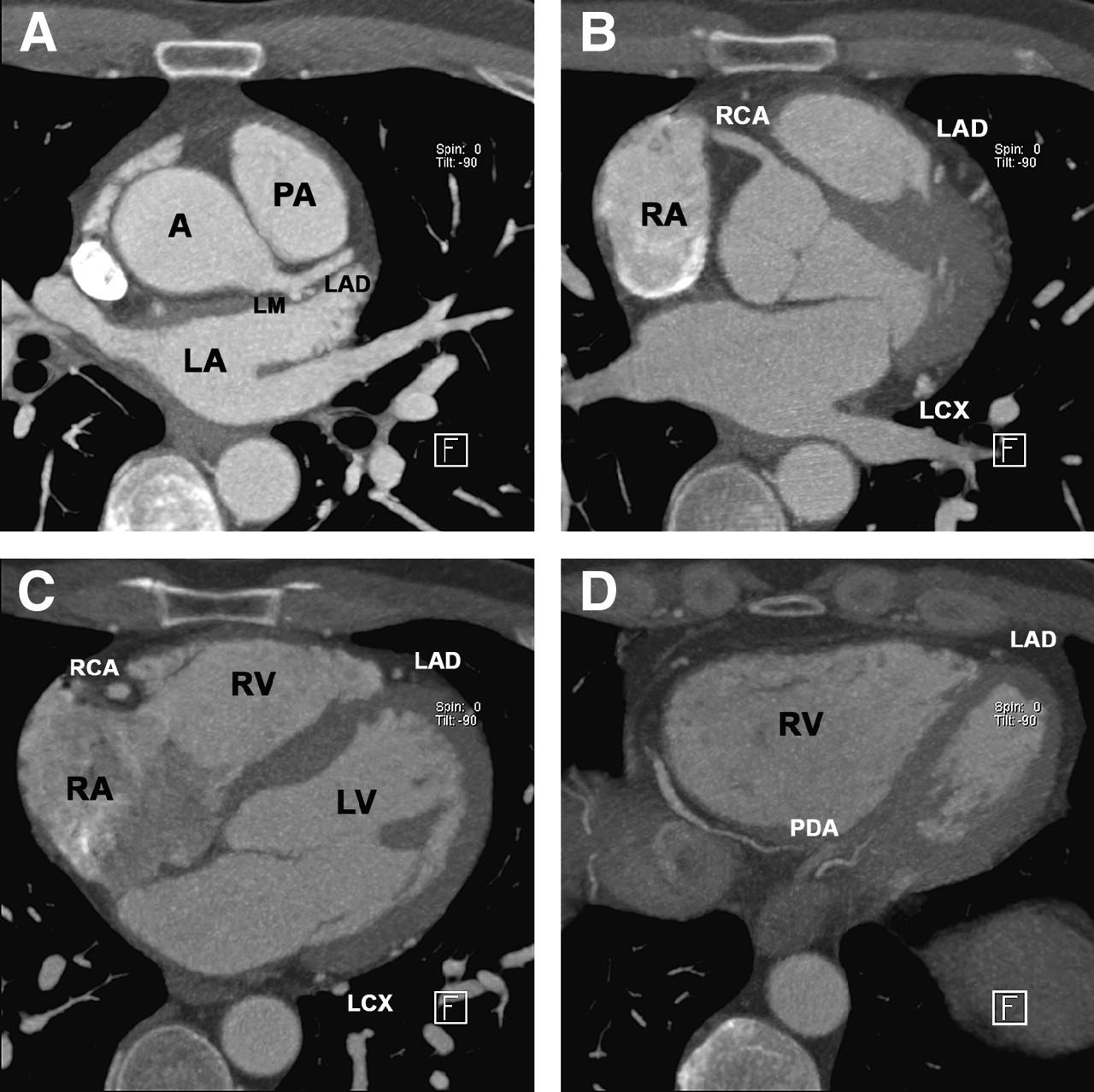 Patient with normal coronary morphology, as visualized by 64-slice MDCT.