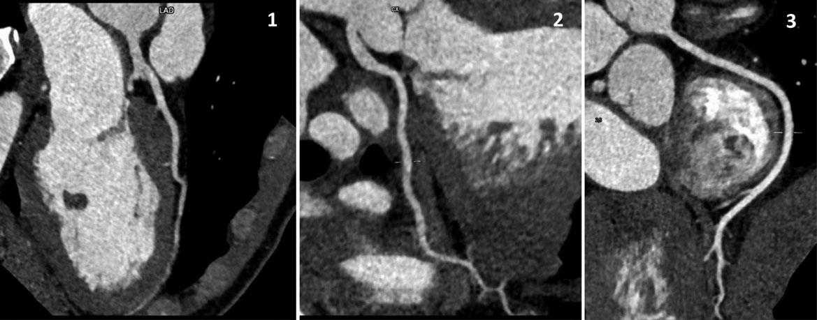 myocardial bridging 15 to 85% at autopsy and 0.