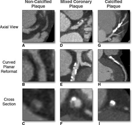 Coronary Atherosclerosis Imaging by Coronary CT Angiography : Current Status,