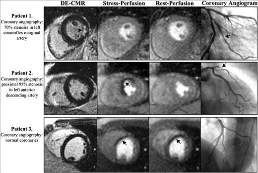 Current ESC guidelines recommend stress CMR alongside other tests as a gate keeper to