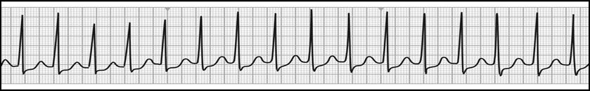 Α. Παπαϊωάννου, Ε. Ασκητοπούλου Κριτήριο Αξιολόγησης 3 Ασθενής μεταφέρεται στο τμήμα επειγόντων με απώλεια συνείδησης. Συνδέεται σε monitor το οποίο δείχνει το κάτωθι ηλεκτροκαρδιογράφημα.