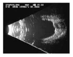 Α και Β υπερηχογραφία στην Δ.Δ. παθήσεων του οπισθίου ημιμορίου το άκρο του ηχοβολέα στους οφθαλμικούς ιστούς είναι ιδιαίτερα σημαντική κατά την εκτέλεση μιας μέτρησης.