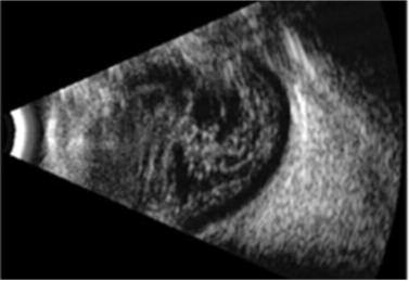 Στην Β- υπερηχογραφία η αποκόλληση του οπισθίου υαλοειδούς φαίνεται σαν μια λεία επιφάνεια παράλληλη με το βυθό (οπίσθια υαλοειδική μεμβράνη).