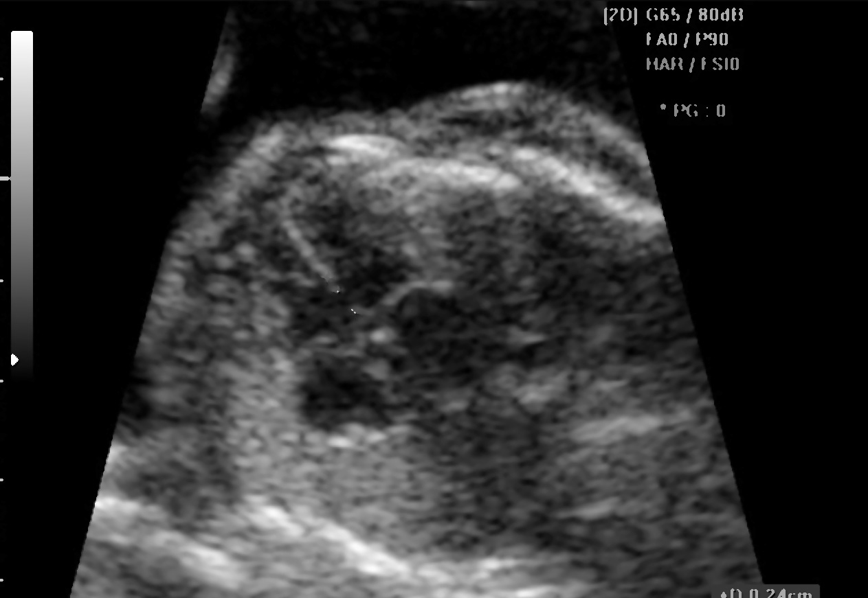 Εικόνα 2: Περίπτωση εμβρύου με σημαντικό έλλειμμα μεσοκοιλιακού διαφράγματος κάτω από τις κολποκοιλιακές βαλβίδες. Εικόνα 3: Απεικόνιση δύο αγγείων στο επίπεδο των τριών αγγείων και τραχείας.