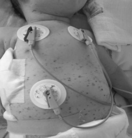 Slika 1. Petehijalna ospa kod meningokokcemije Neposredno zbrinjanjanje bolesnika sa sumnjom na sepsu obuhvata obezbeđenje oksigenacije (kiseonik).