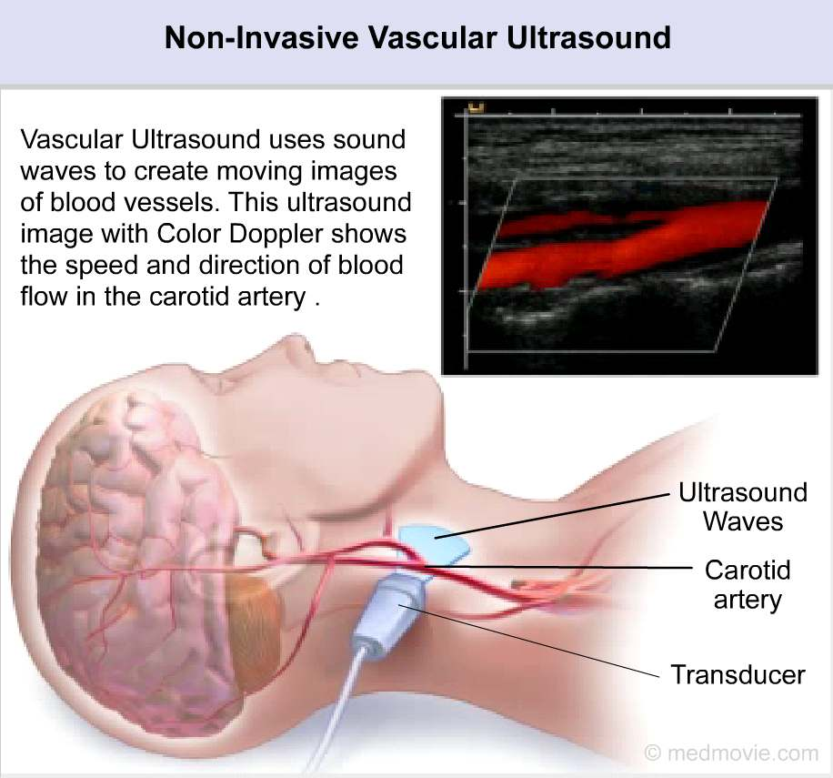 Curgere laminară intr-o carotidă