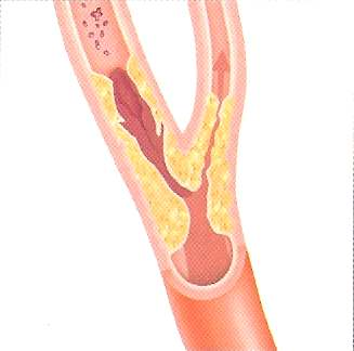 Aspecte hemodinamice patologice Patologia vasculara - stenoze: Scaderea fluxului