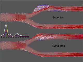 Patologie vasculara David Steinman, University