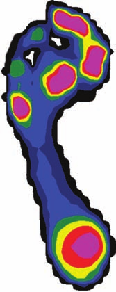 Πεδογραφία Η Πεδογραφία είναι το εργαλείο για την έγκαιρη διάγνωση των αλλαγμένων προτύπων πιέσεων κάτω από την πελματική επιφάνεια των ποδιών για τα άτομα με διαβήτη.
