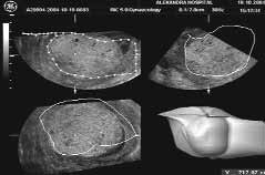 ΥΠΕΡΗΧΟΓΡΑΦΙΑ ΤΟΜ.1, ΤΕΥΧ.4, ΣΕΛ. 257-262, 2004 Εικόνα 8: 3D: Όγκος ενδομητρικής κοιλότητας. ση, μετά από διακοπή κύησης (αυτόματη ή τεχνητή) ή ακόμα μετά από μια έκτοπη εγκυμοσύνη.