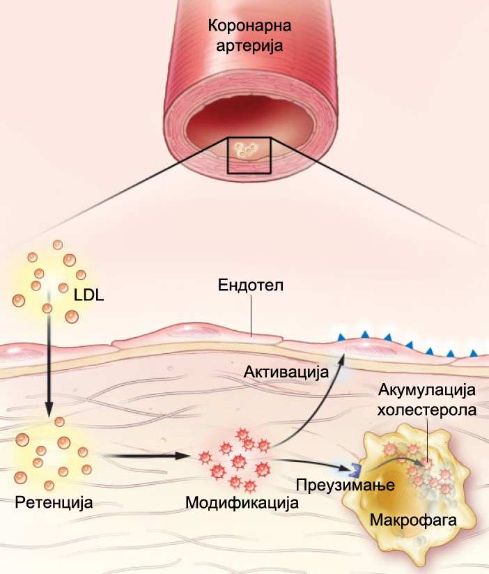то продором LDL-а у тунику интиму (Слика 2).