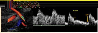 Εικόνα 14: Υπερηχογράφημα Doppler. Βλέπετε τη ροή του αίματος των μητριαίων αγγείων και την κυματομορφή στις 24 εβδομάδες της κύησης, σε φυσιολογική (Α) και προεκλαμπτική (Β) έγκυο.
