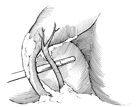 bile duct injury 34