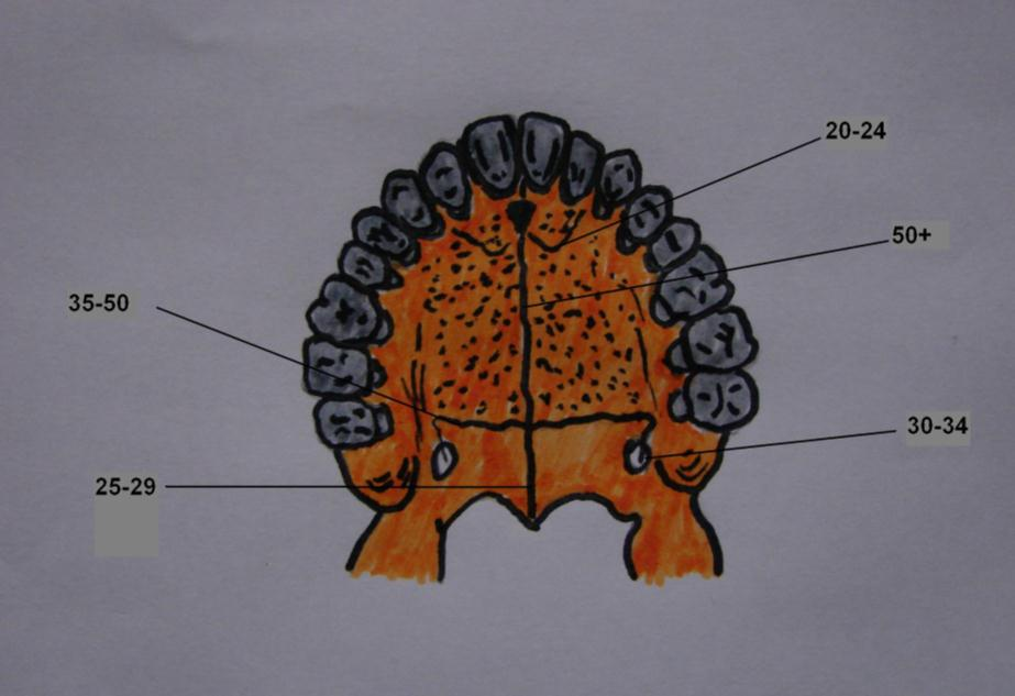 Εικόνα 30 - Γενικό πρότυπο της σύγκλεισης των υπερώιων ραφών σε ενήλικο σκελετό Πίνακας ΦIV.