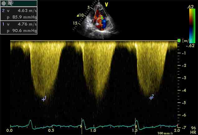 Διαθωρακικό ηχωκαρδιογράφημα - Doppler στιγμιαία