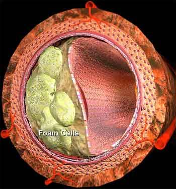 Στην επιτάχυνση του μετασχηματισμού των μακροφάγων σε αφρώδη κύτταρα εμπλέκονται επίσης και αυτοάνοσα σύμπλοκα.