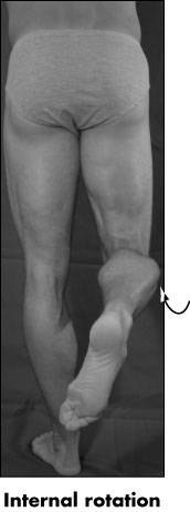 tibia, Intermediate patellofemoral liður á milli patella og