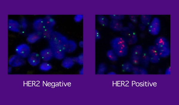 Herceptin (trastuzumab) και ΕGFR (HER-2) για τη θεραπεία καρκίνου του