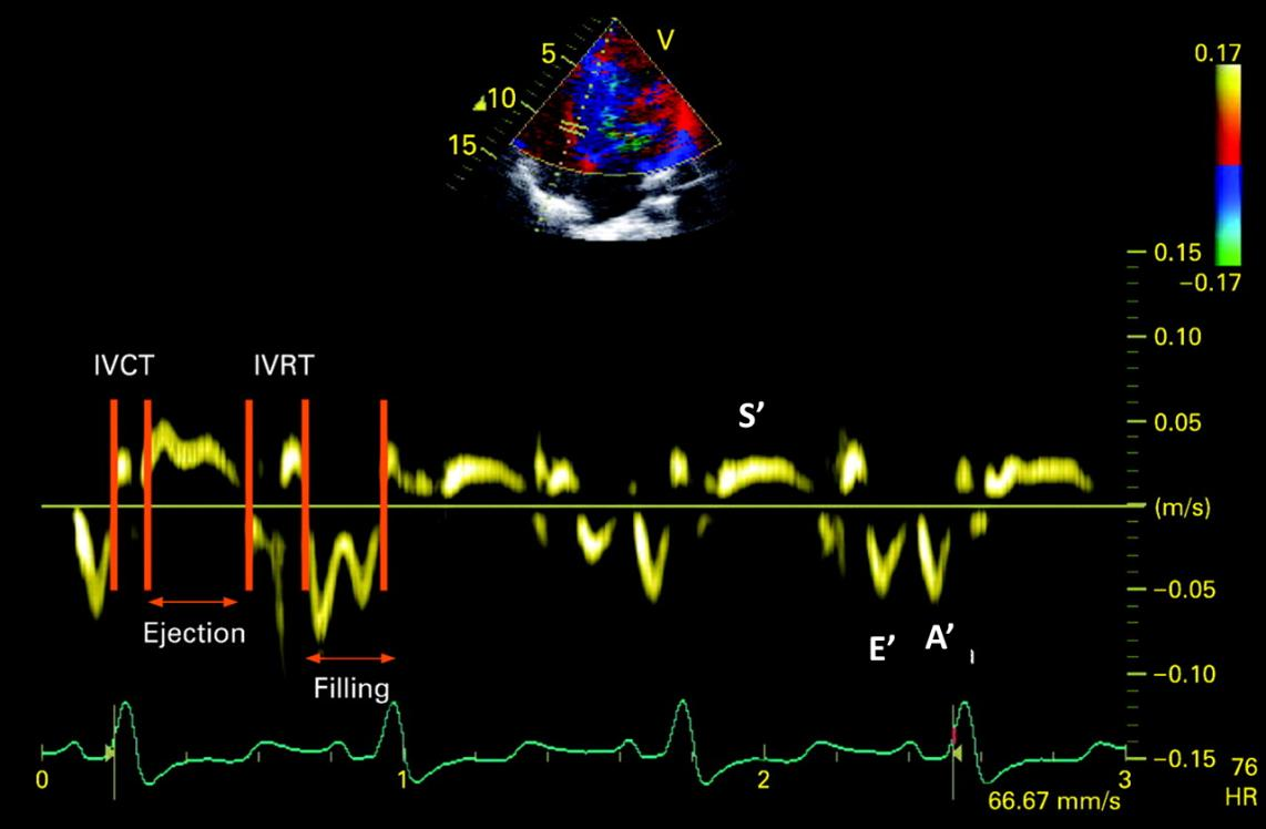 Εικόνα Ι.Β.3. Υπερηχοκαρδιογράφημα με την τεχνική TDI.