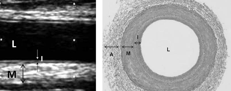 Εικόνα Ι.Β.4. Υπερηχογραφική και ιστολογική απεικόνιση των στρωμάτων του τοιχώματος της καρωτίδας. L: αυλός αγγείου, I: έσω χιτώνας, M: μέσος χιτώνας, A: έξω χιτώνας.
