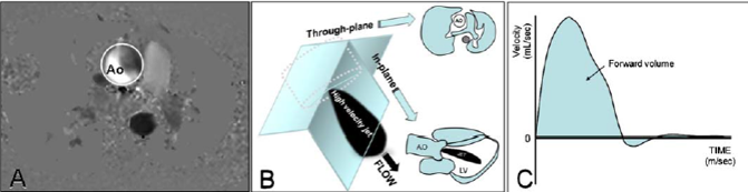 Μέτρηση όγκου ροής Christiansen JP, Karamitsos, TD, Myerson SG. Heart Lung Circ.