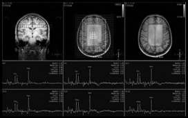 ΰΰ δκζκΰδεσ παεϋ κ (MR Angiography) Χαλαε βλδ δεϊ: Φα ηα κ εκπέα απζκτ σΰεκυ Φα ηα κ εκπέα πκζζαπζυθ-voxel (1D εαδ 2D) Kα α κζά άηα κμ θ λκτ υθαηδεά φα ηα κ εκπέα (ξλκθδεϋμ δλϋμ, πκ κ δεϋμ T1 εαδ T2