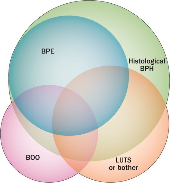 3 BOO (Bladder Outlet Obstruction) Τι είναι η αποφρακτική ΚΥΠ; BPO (Benign Prostatic Obstruction) BPE (Benign Prostatic Enlargement) BPH (Benign Prostatic Hyperplasia) 4