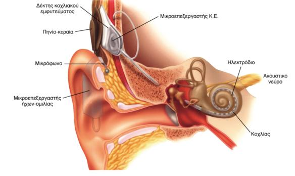 εισάγεται στον κοχλία και μεταφέρει τις πληροφορίες μέσω ηλεκτρονικών παλμών απευθείας στο ακουστικό νεύρο.
